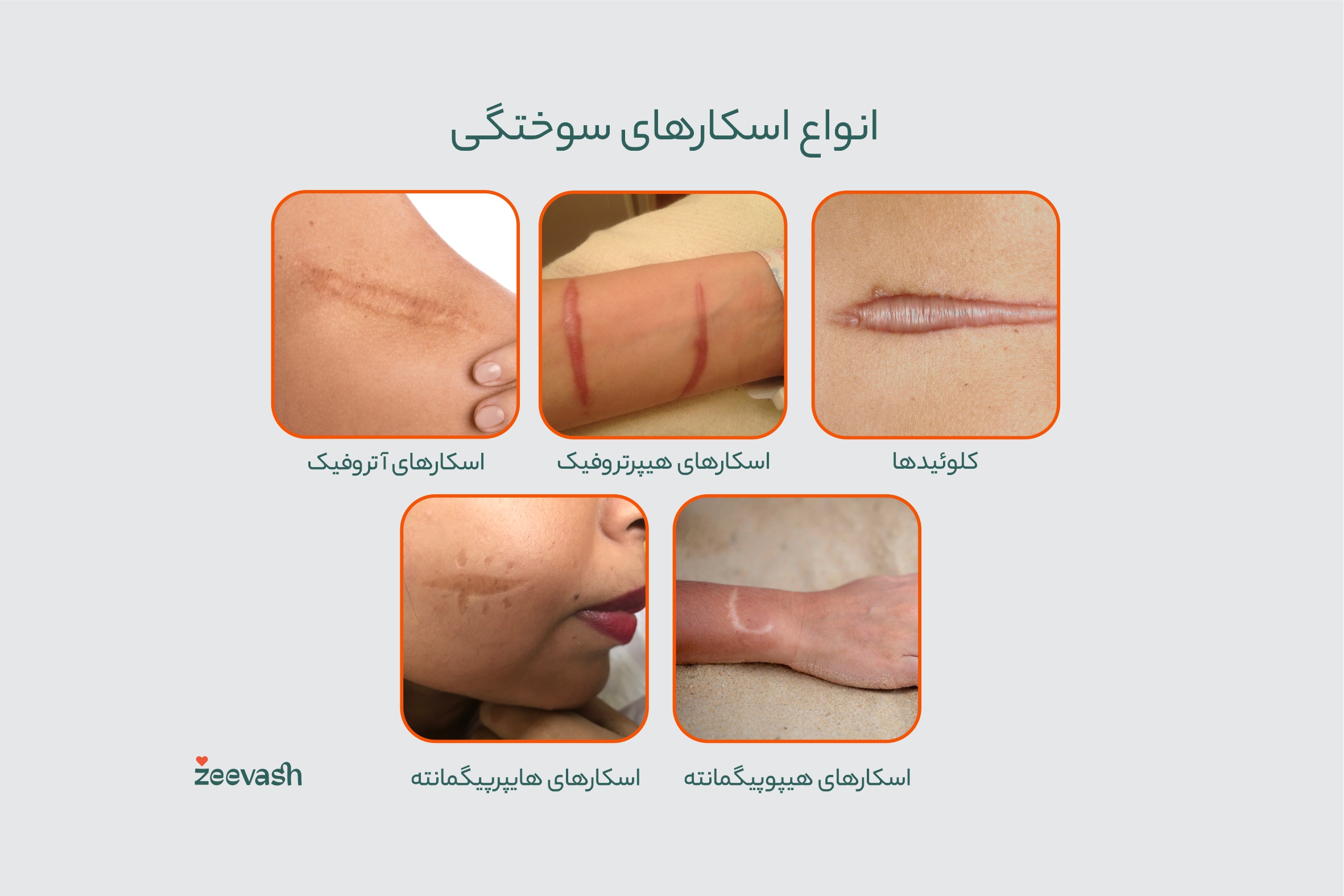 انواع اسکارهای سوختگی